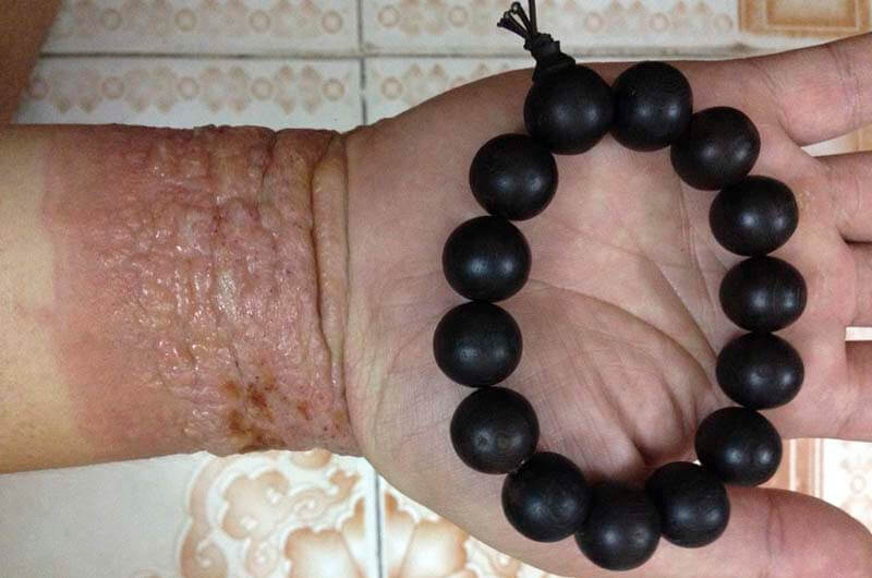 Dễ gây dị ứng da khi đeo